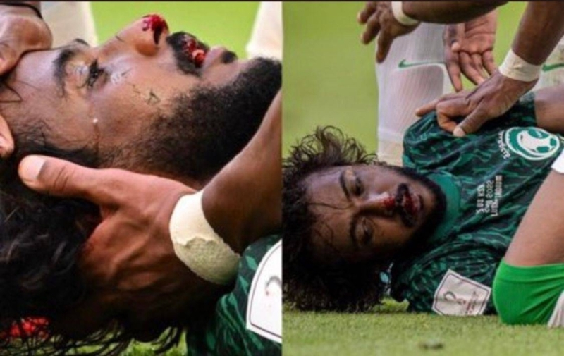 الاتحاد السعودي يكشف حالة اللاعب الشهراني بعد اصابته .. صور