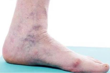 6 أسباب غير متوقعة لجلطات الأوردة العميقة