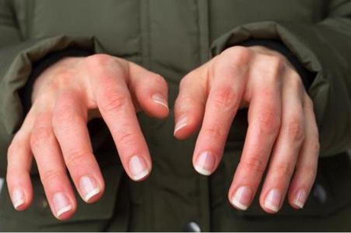 8 اسباب لبرودة اليدين