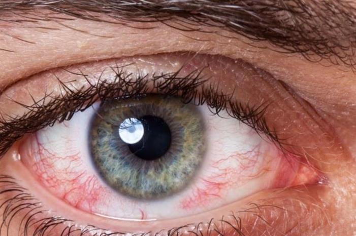 صورة حول : 5 أسباب تؤدي لاحمرار العين 5 أسباب تؤدي لاحمرار العين