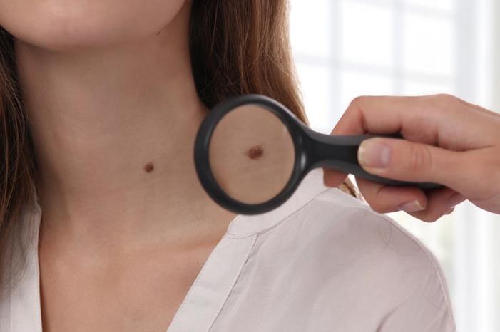 هل يجب أن تقلقي من كثرة الشامات في بشرتكِ؟