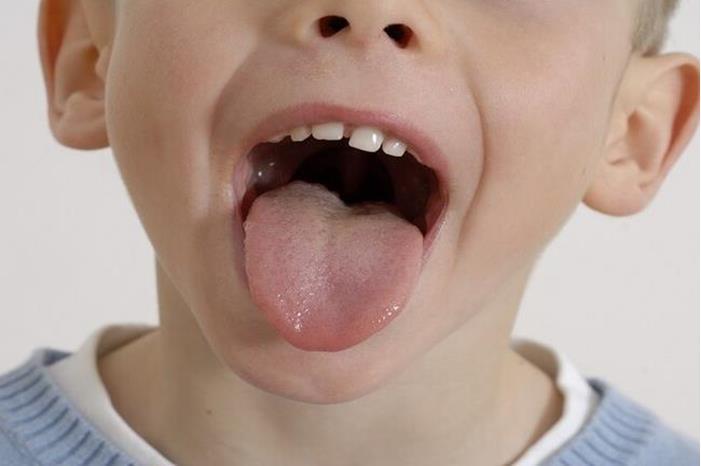 تغيرات في اللسان قد تكشف السرطان