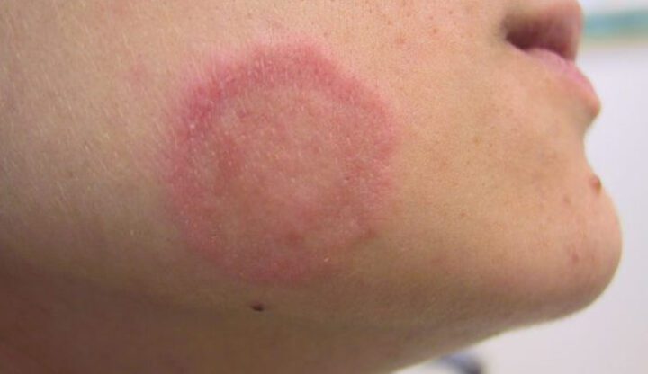 صورة حول : كيف تنتقل عدوى "السعفة" في حمامات السباحة كيف تنتقل عدوى "السعفة" في حمامات السباحة