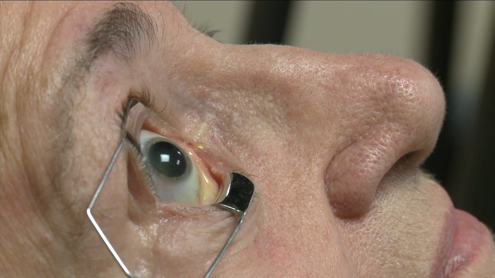 الميلاتونين يحمي المسنين من التنكس البقعي