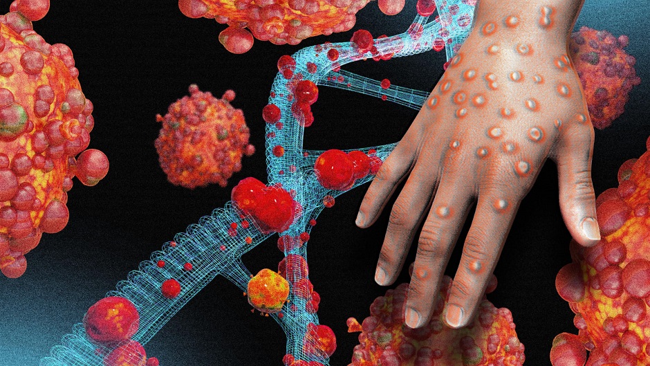 كيف أثر الإهمال في تفشي جدري القردة وظهور نسخ جديدة؟