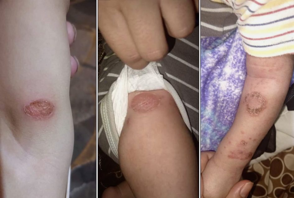 صورة حول : عاجل | صحّة معان تؤكد حالات الطفح الجلدي فِي المحمدية ليست مقلقة عاجل | صحّة معان تؤكد حالات الطفح الجلدي فِي المحمدية ليست مقلقة