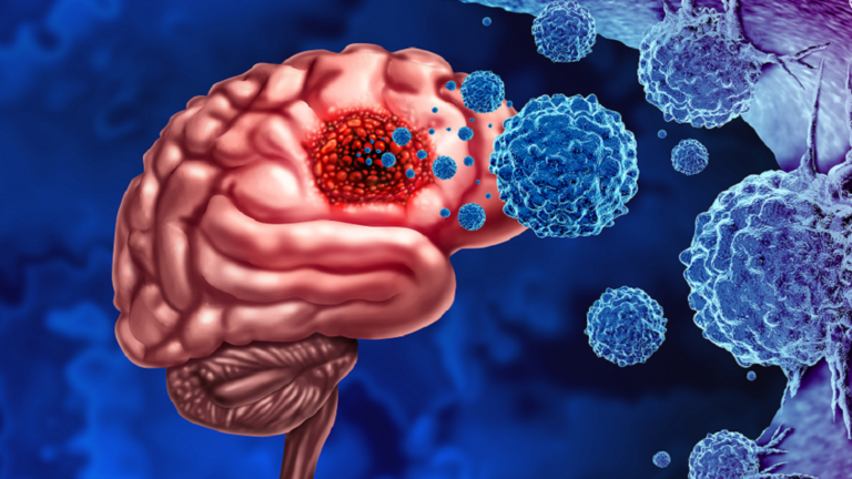 صورة حول : باحثون يطورون آليات جديدة لمكافحة الورم الأرومي الدبقي العدواني باحثون يطورون آليات جديدة لمكافحة الورم الأرومي الدبقي العدواني