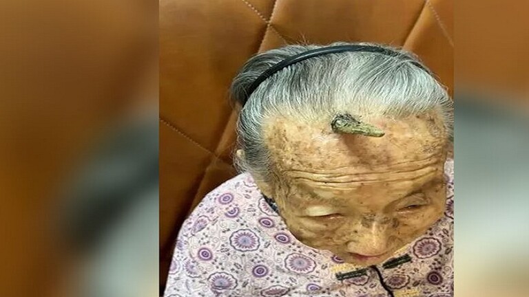 صورة حول : “قرن طول العمر” يظهر على جبهة عجوز صينية تبلغ 107 أعوام “قرن طول العمر” يظهر على جبهة عجوز صينية تبلغ 107 أعوام