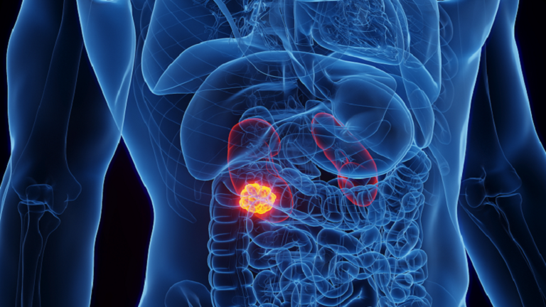 دراسة تكشف دور النحاس في تطور سرطان الخلايا الكلوية