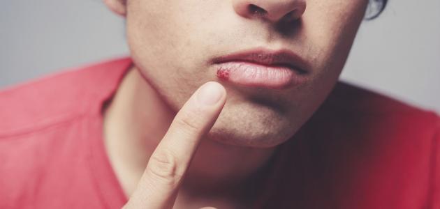 صورة حول : كيف يمكن التخفيف من آلام حمو الفم والتعامل مع قروحه؟ كيف يمكن التخفيف من آلام حمو الفم والتعامل مع قروحه؟