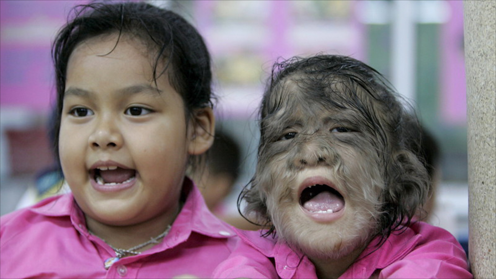 "مرض المستذئب".. حالة نادرة تحول الإنسان إلى مخلوق مشعر