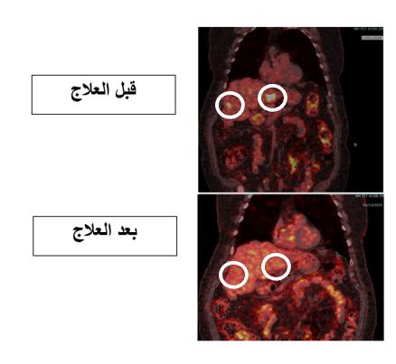 إنجاز طبي جديد بعلاج السرطان في مستشفى الملك المؤسس