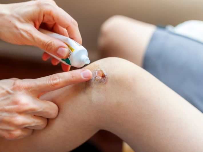 التهاب الجرح: الأسباب، الأعراض وطرق العلاج الفعالة