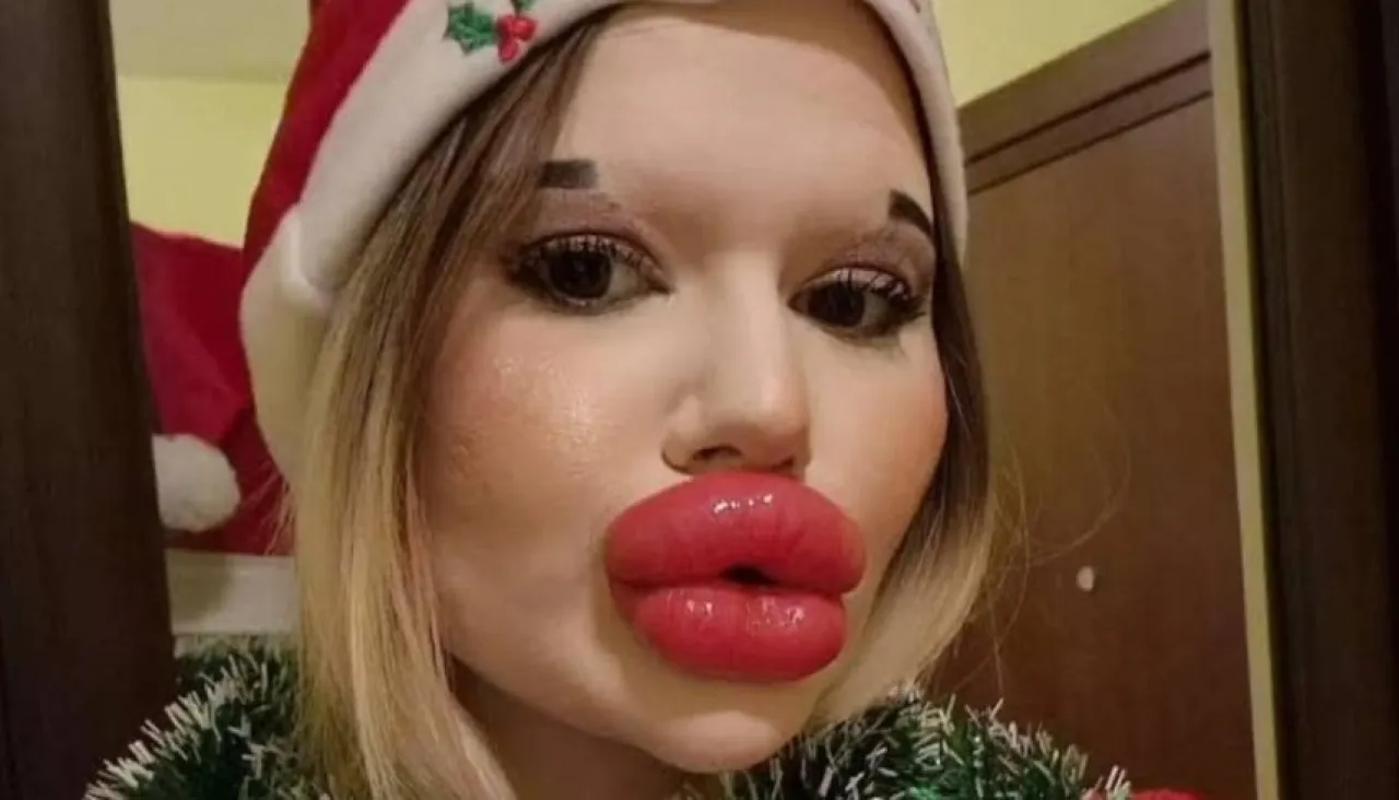 صورة حول : رفض طبي بسبب مظهرها.. صاحبة "أكبر شفاه في العالم" تصطدم برفض العلاج رفض طبي بسبب مظهرها.. صاحبة "أكبر شفاه في العالم" تصطدم برفض العلاج