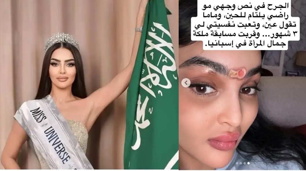 ملكة جمال السعودية تكشف عن إصابات جديدة في وجهها