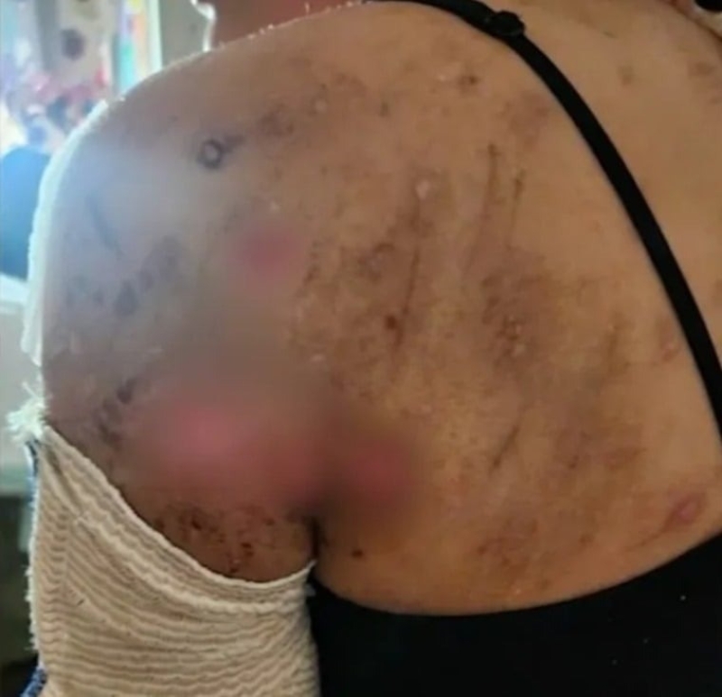 صورة حول : 10 كلاب تهاجم مراهقة وتدخلها المستشفى بـ500 غرزة في أمريكية 10 كلاب تهاجم مراهقة وتدخلها المستشفى بـ500 غرزة في أمريكية