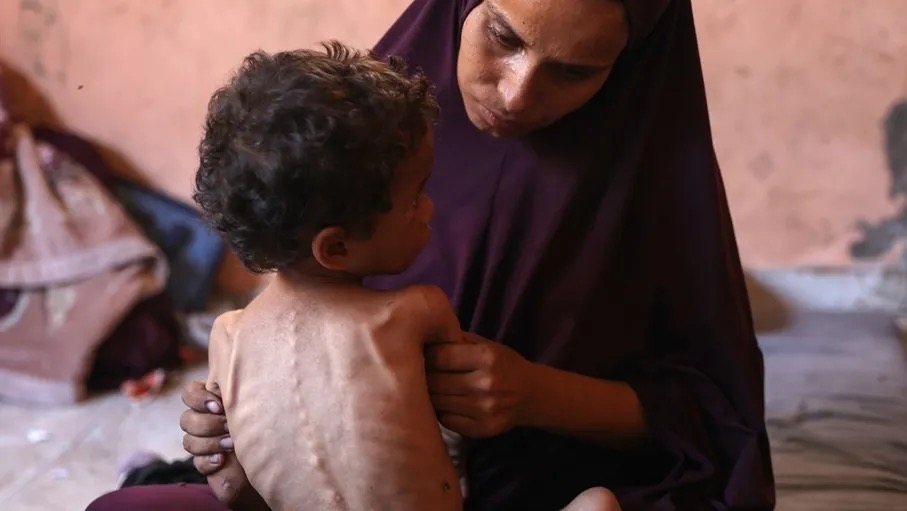 اكثر من 17 ألف طفل يعانون سوء التغذية وأدوية مرضى السكري لا تصل