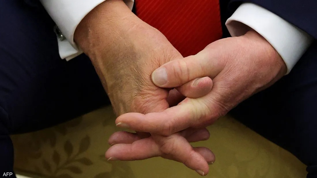 صورة حول : جدل حول كدمات يد ترامب يثير تساؤلات عن صحته جدل حول كدمات يد ترامب يثير تساؤلات عن صحته