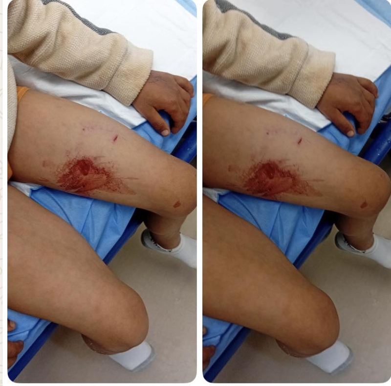 هجوم كلب ضال ينهش جسد طفل في القطرانة .. صور