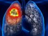استراتيجية جديدة لاعتراض سرطان الرئة المبكر قد تحسن حياة المرضى