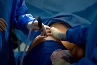 باحثون يطورون ذكاءً اصطناعيًا لتقليل مخاطر شفط الدهون