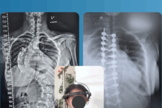 إنجاز طبي جديد في جراحة العمود الفقري بمستشفى حمزة