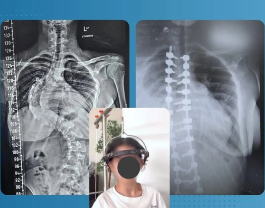 إنجاز طبي جديد في جراحة العمود الفقري بمستشفى حمزة