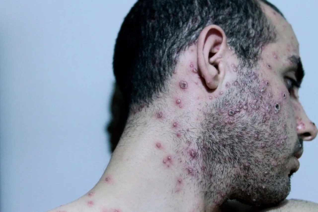 إسرائيل تسجل أول إصابة بجدري القرود من النمط الفرعي 1ب