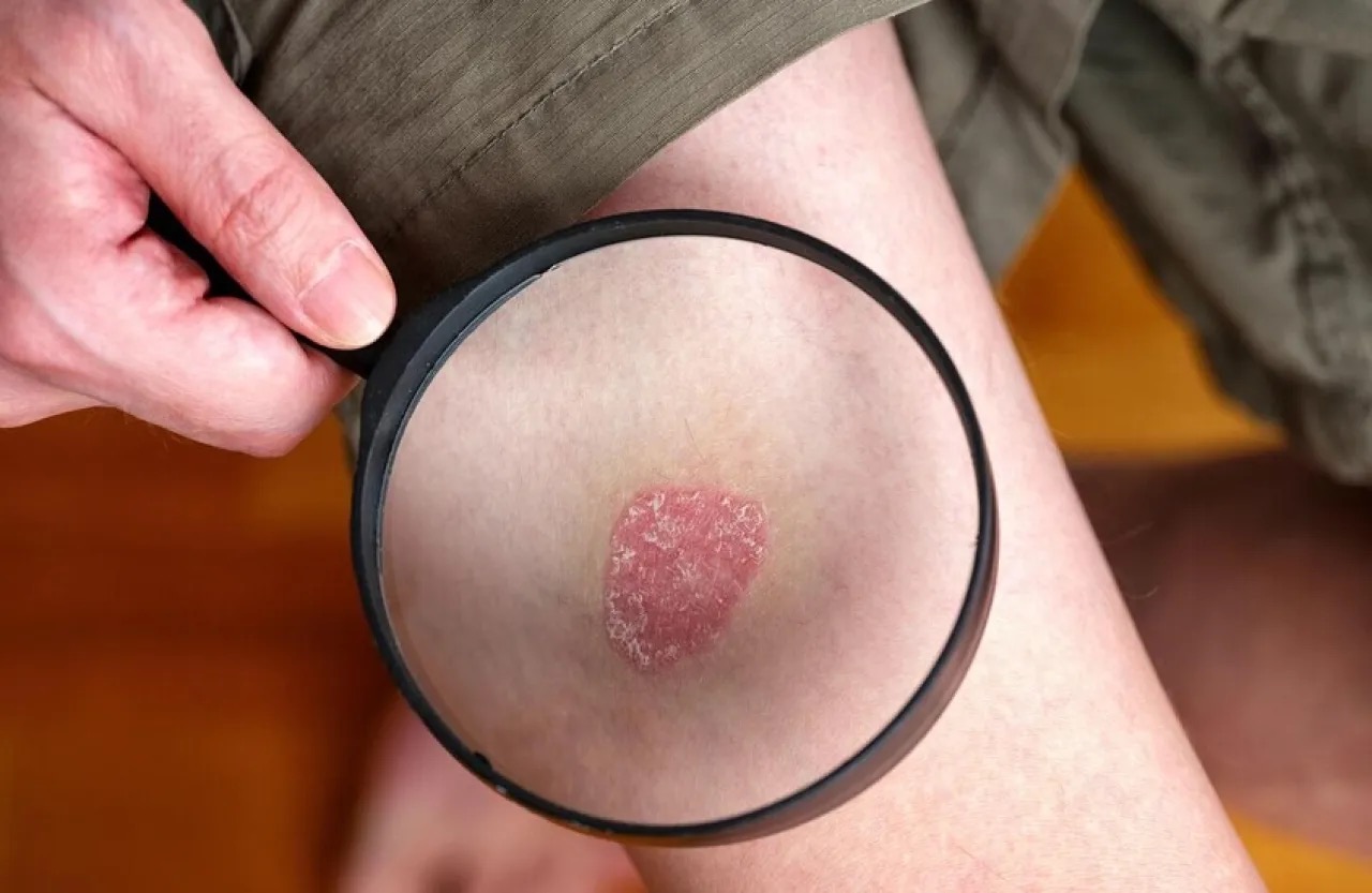 صورة حول : دراسة بريطانية: النظام النباتي قد يخفف أعراض الصدفية دراسة بريطانية: النظام النباتي قد يخفف أعراض الصدفية