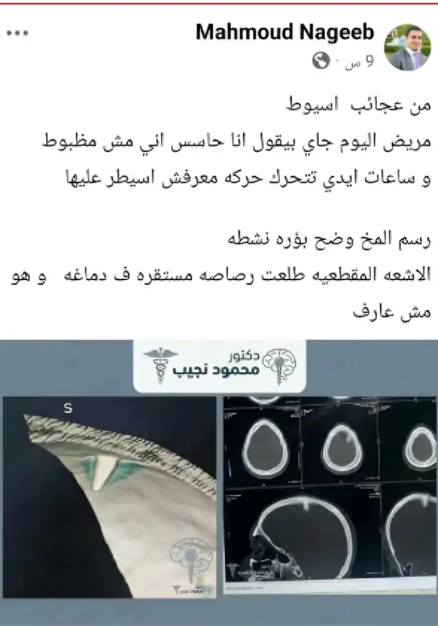 مريض في مصر يكتشف بالمصادفة رصاصة مستقرة بدماغه 